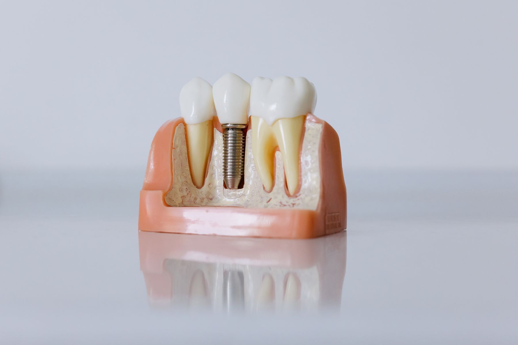 Il modello di un impianto dentale accanto a due denti naturali, con osso e gengiva in sezione